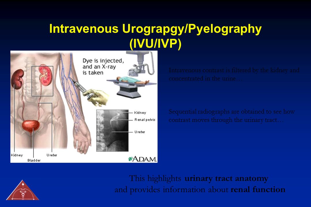 Intravenous Urograpgy/Pyelography (IVU/IVP)