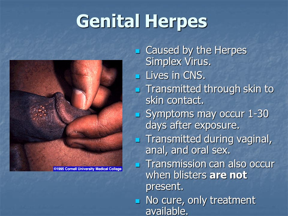 Genital herpes