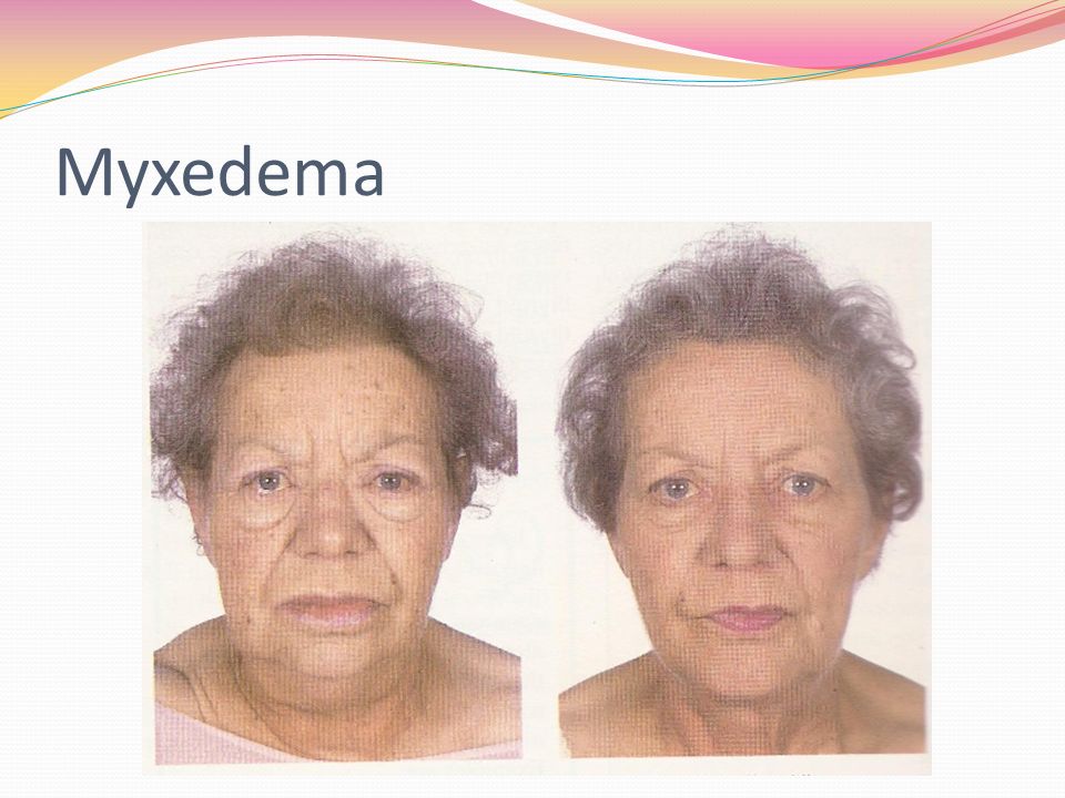 File:PSM V51 D499 Myxoedema before and after treatment.png - Wikimedia Commons