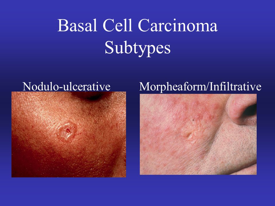 Skin Cancer Incidence Over 1 Million New Cases Of Bcc Scc Ppt