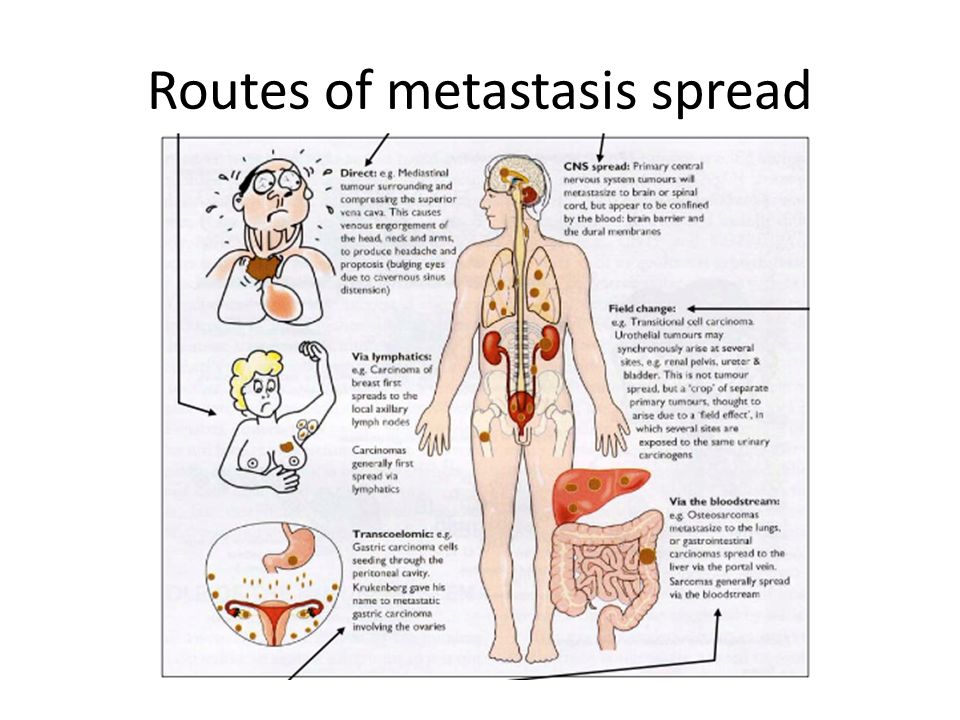 Routes of metastasis spread