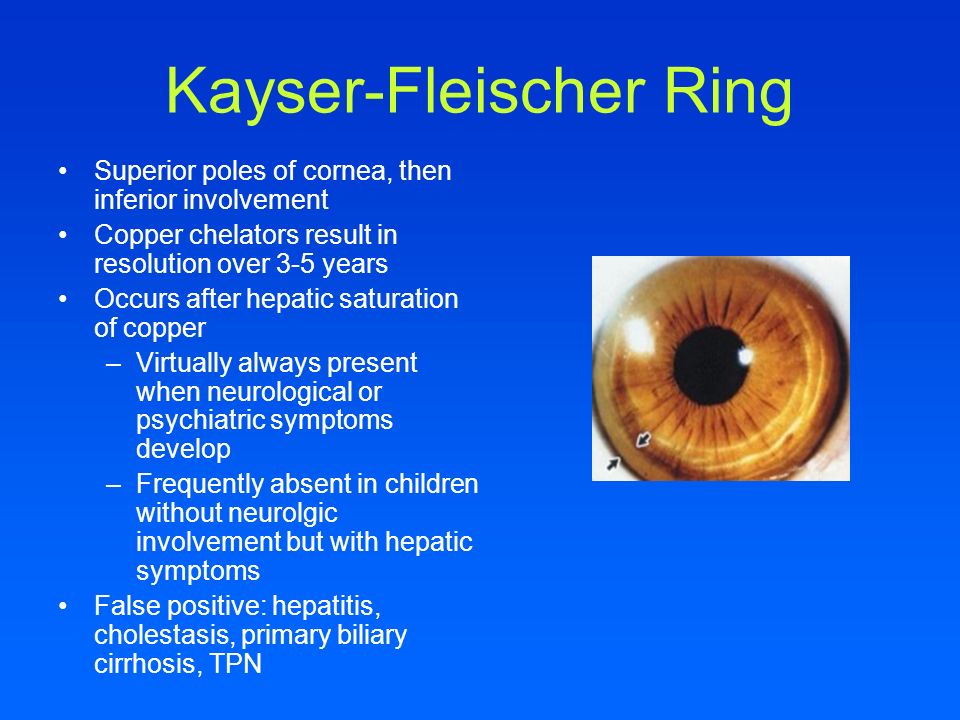 Kayser Fleischer+Ring
