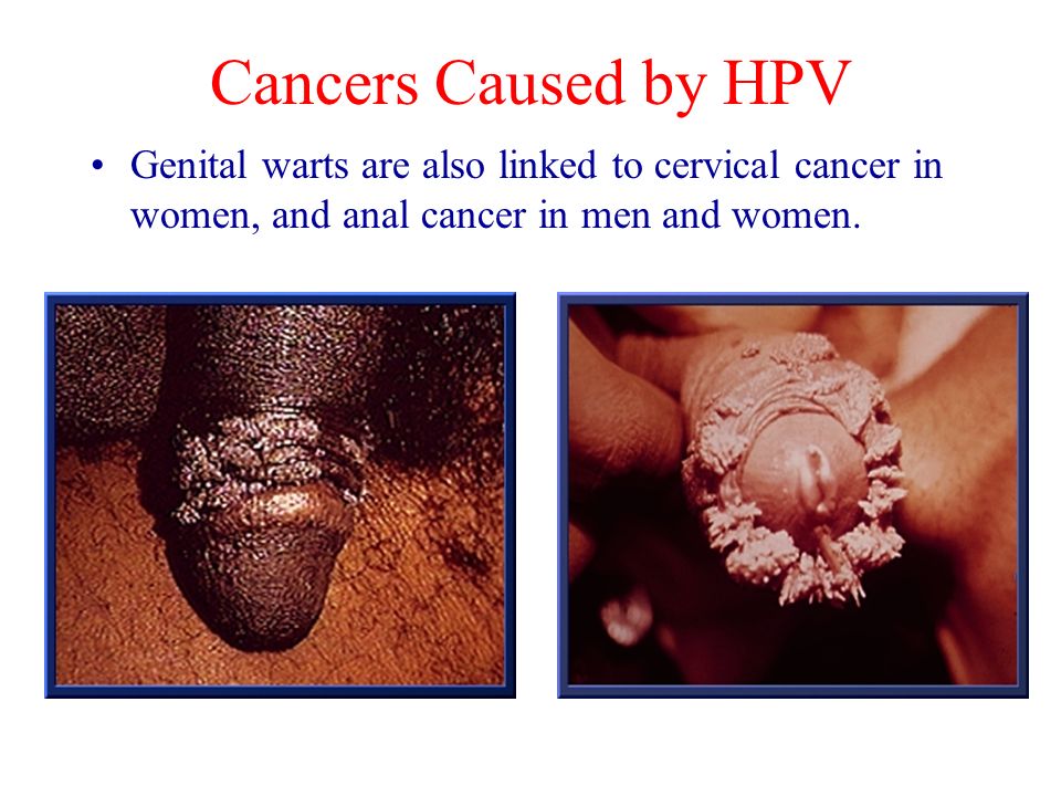 Genital warts are also linked to cervical cancer in women, and anal cancer ...