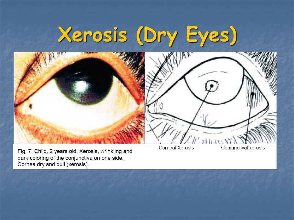 Xerophthalmia Literaly Means Dry Eye Ppt Video Online Download