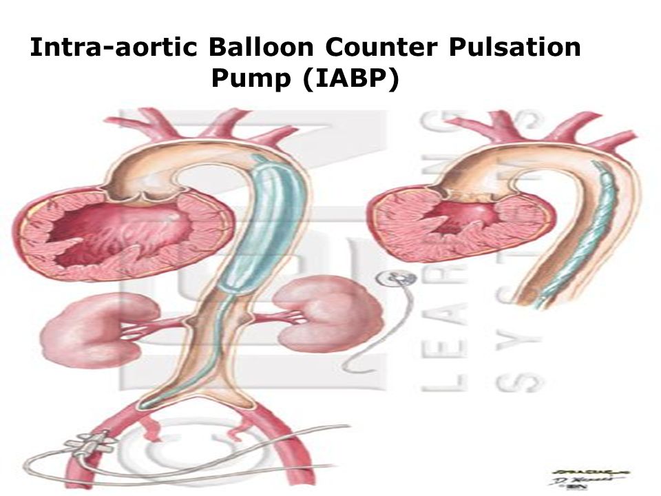 Arrow Intra-Aortic Balloon Pump - ppt download