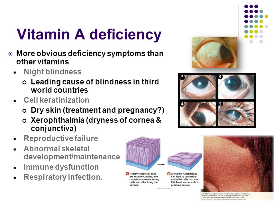 Vitamin deficiency. Ксерофтальмия наблюдается. Возникает ксерофтальмия.