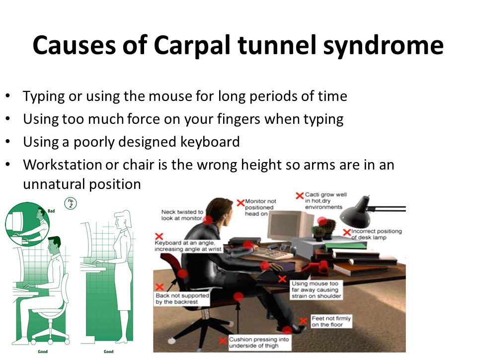 Causes of Carpal tunnel syndrome