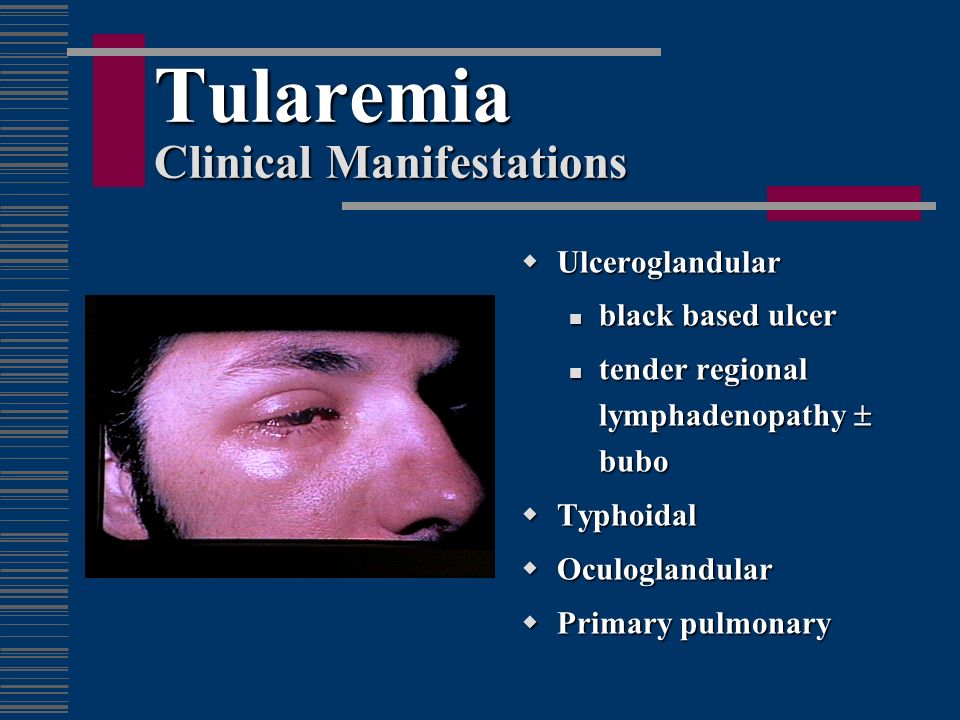 Tularemia Clinical Manifestations