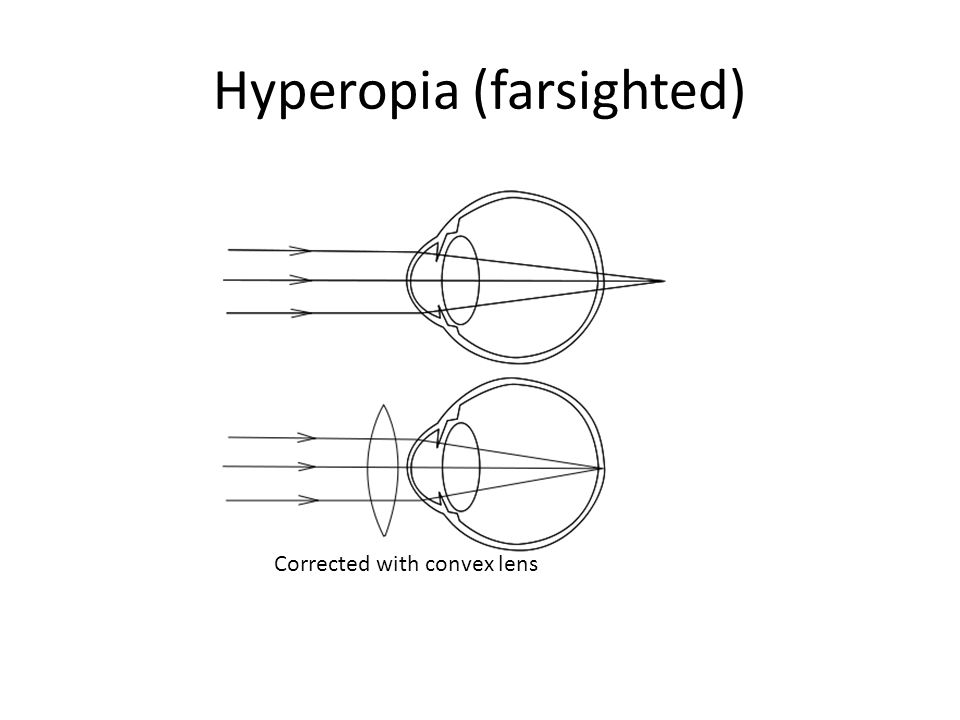 5 hyperopia
