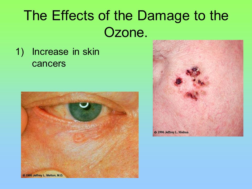 The Effects of the Damage to the Ozone.