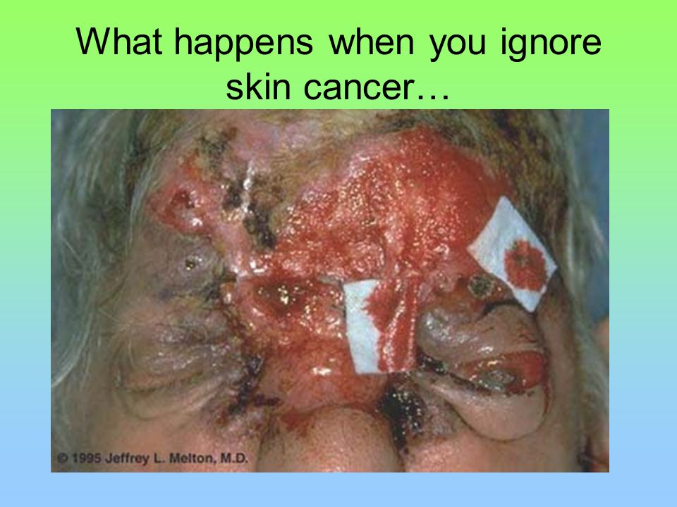 What happens when you ignore skin cancer…