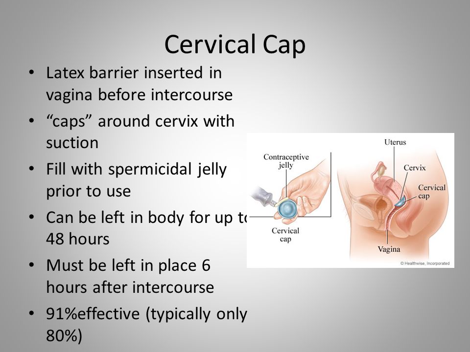 Cervical Cap Latex barrier inserted in vagina before intercourse