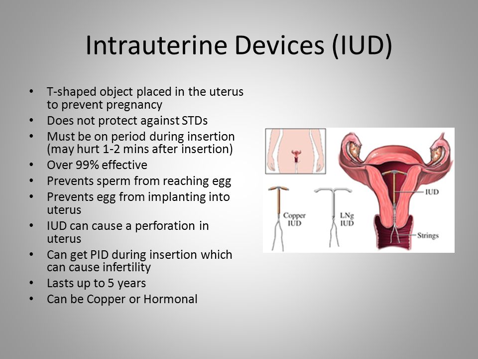 Intrauterine Devices (IUD)