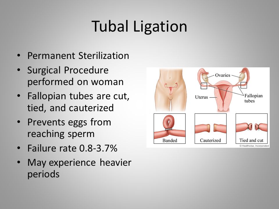 Tubal Ligation Permanent Sterilization