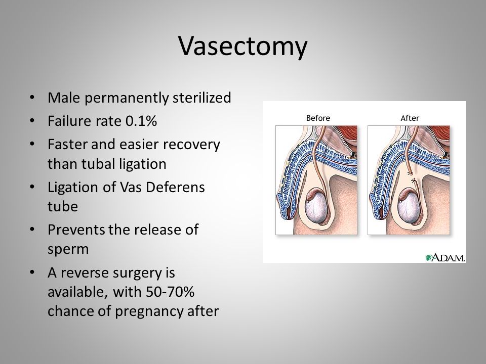 Vasectomy Male permanently sterilized Failure rate 0.1%