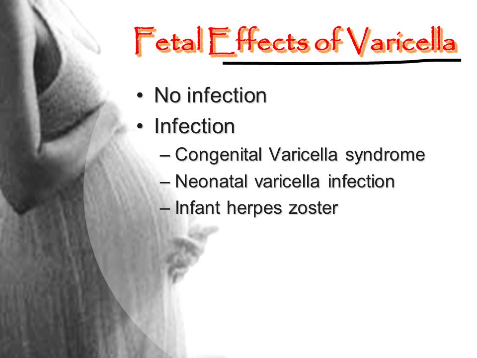 Fetal Effects of Varicella