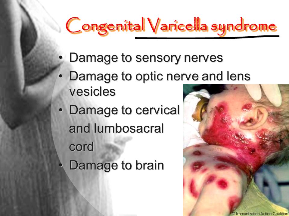 Congenital Varicella syndrome