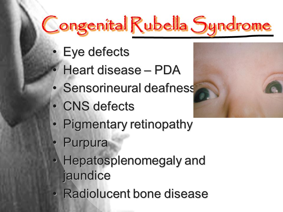 Congenital Rubella Syndrome