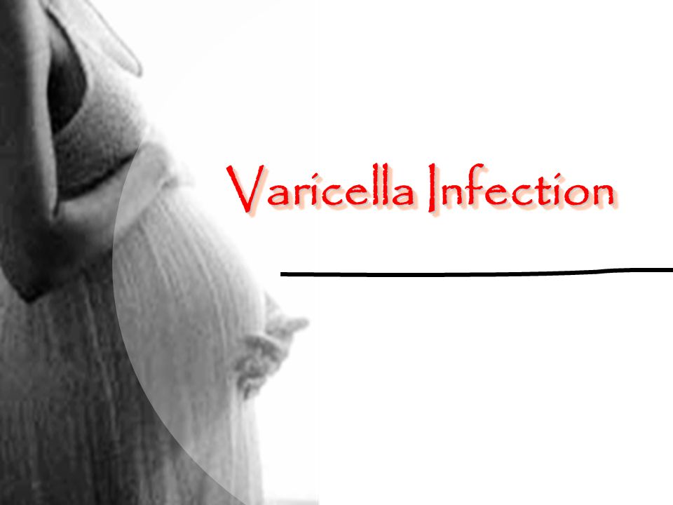 Varicella Infection