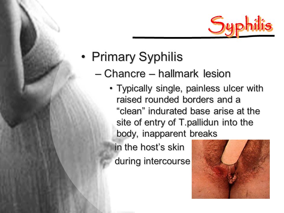 Syphilis Primary Syphilis Chancre – hallmark lesion