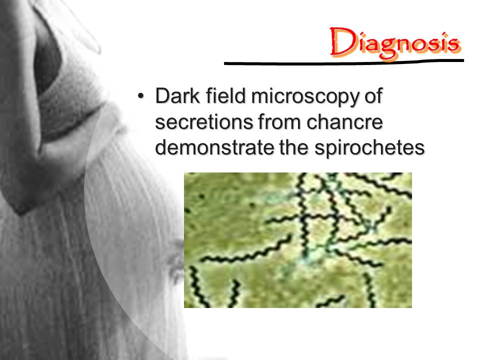 Diagnosis Dark field microscopy of secretions from chancre demonstrate the spirochetes