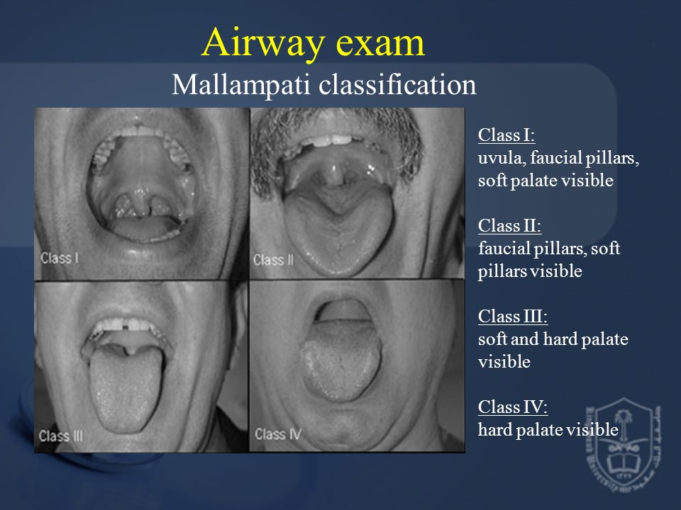 Airway exam Mallampati classification Class I: