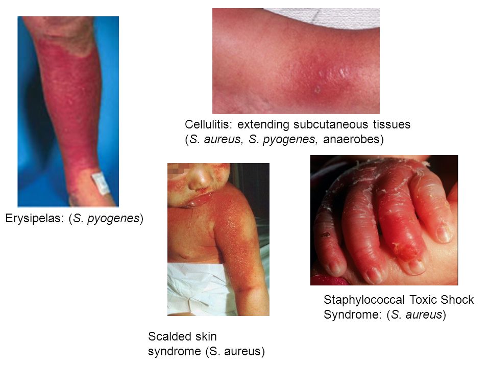 11 Cellulitis: extending subcutaneous ...