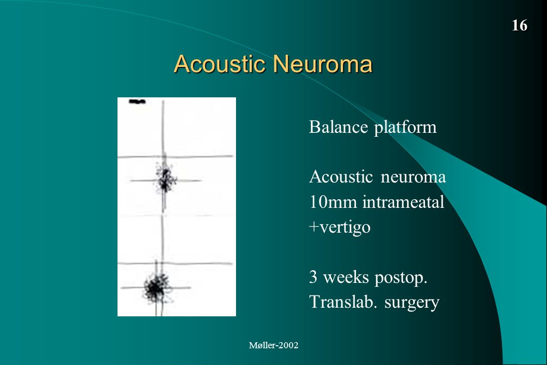 Acoustic Neuroma Balance platform Acoustic neuroma 10mm intrameatal