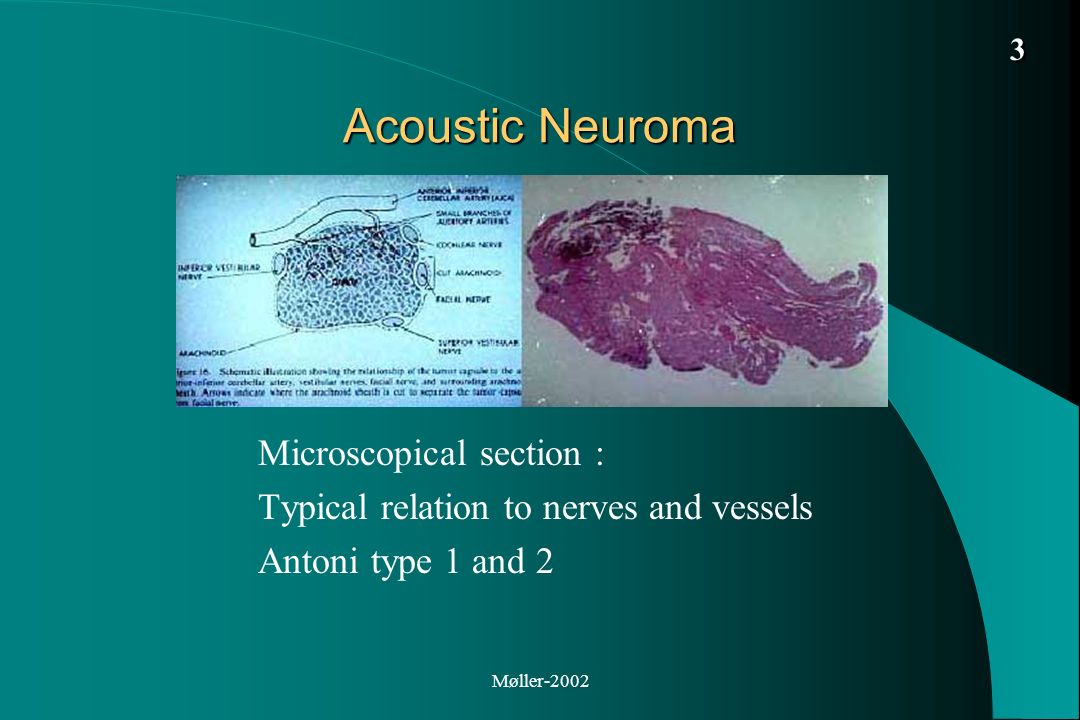Acoustic Neuroma Microscopical section :