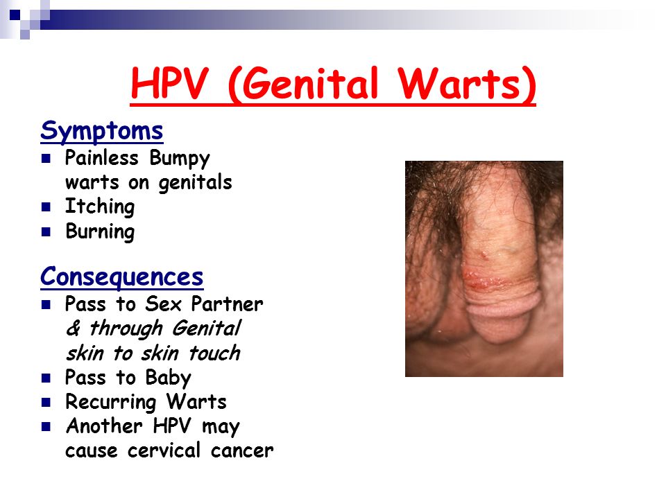 The risk for males of contracting various stds through one