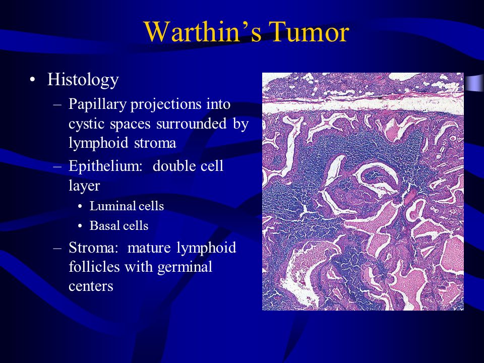 warthin's tumor histology A termékenység kezelése krónikus prosztatitisben