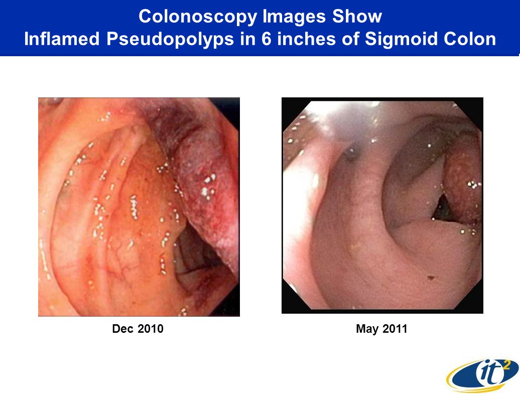 Applicability Of Sigmoid Colon Graft For Vaginal Replacement