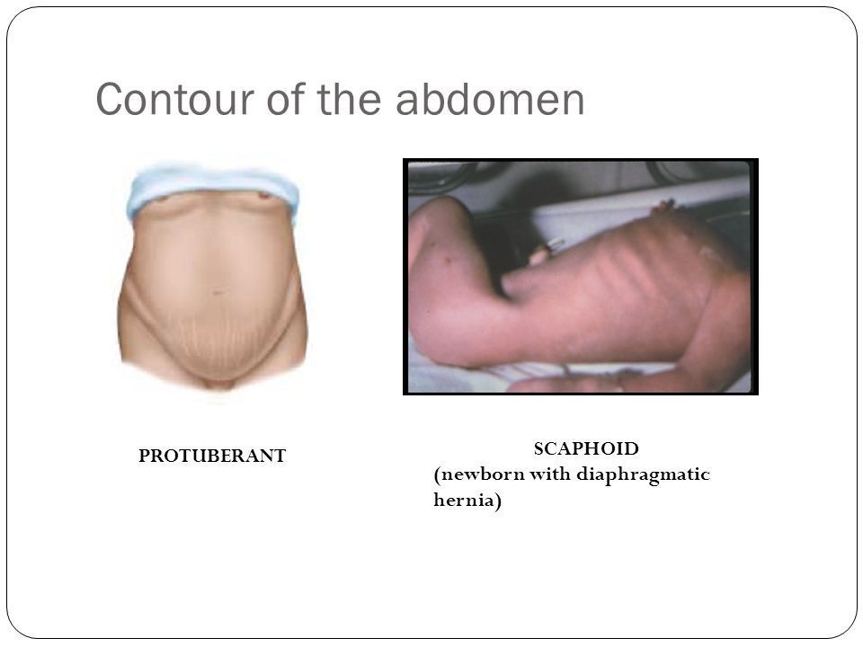 Scaphoid abdomen