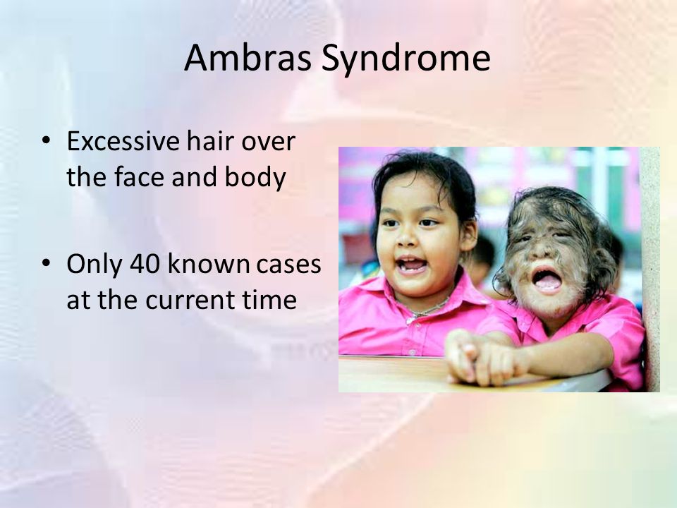 ambras syndrome baby