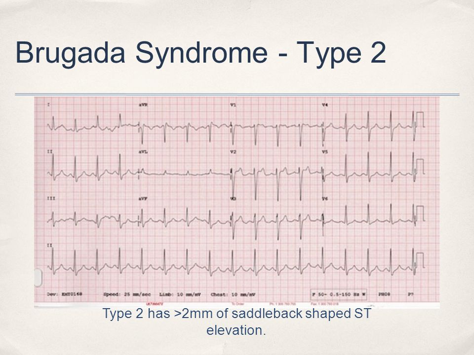 Синдром бругада на экг фото