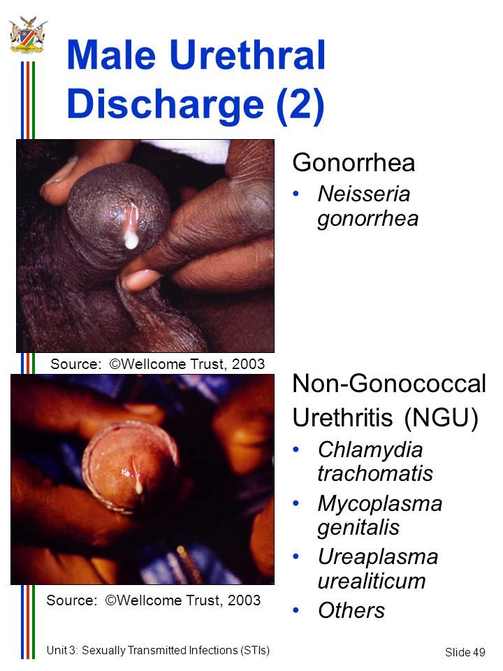 Male penis yellow discharge