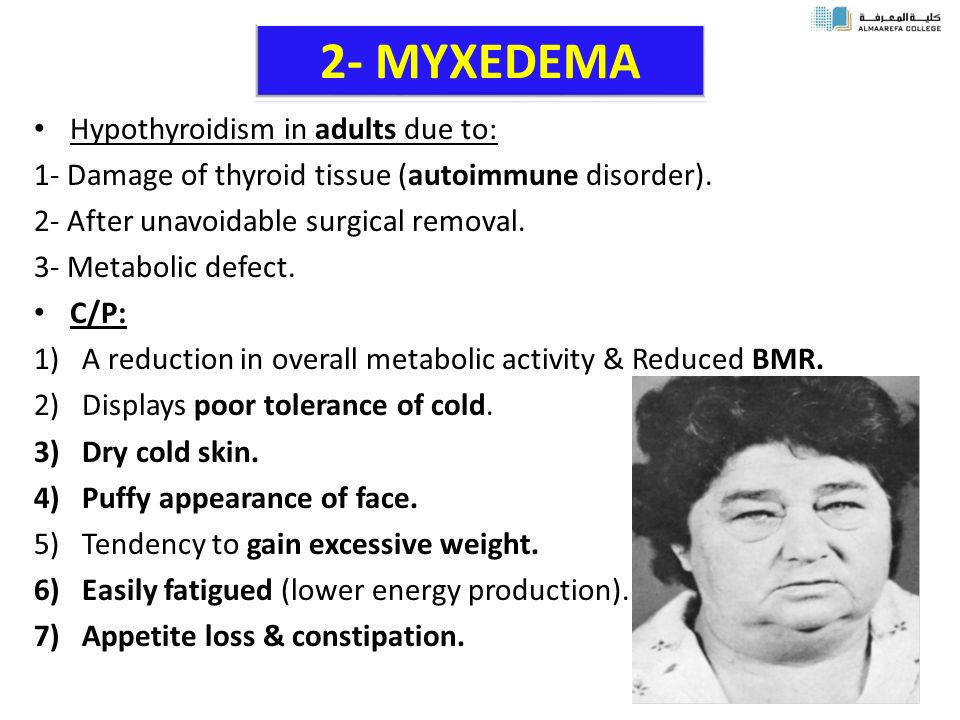 2- MYXEDEMA Hypothyroidism in adults due to: