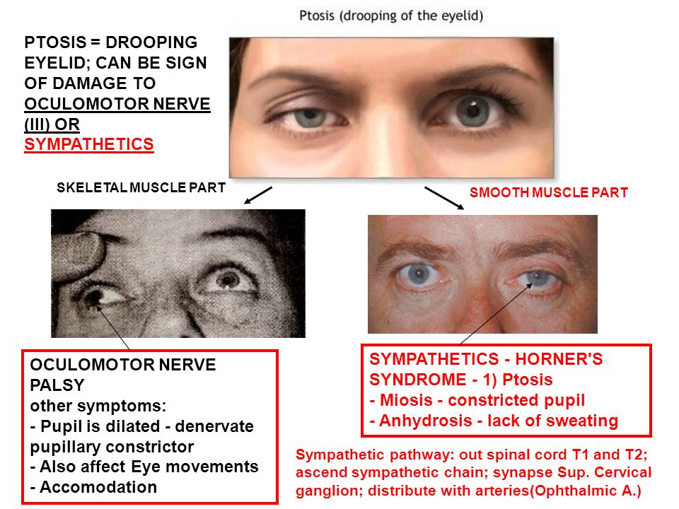 PTOSIS = DROOPING EYELID; CAN BE SIGN OF DAMAGE TO