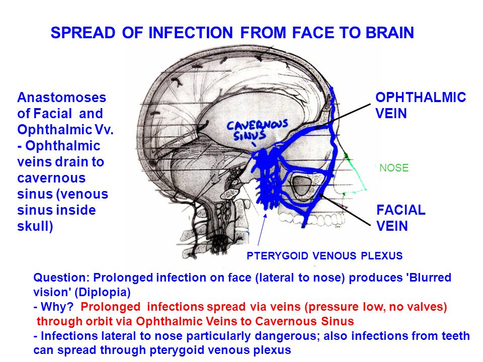 SPREAD OF INFECTION FROM FACE TO BRAIN