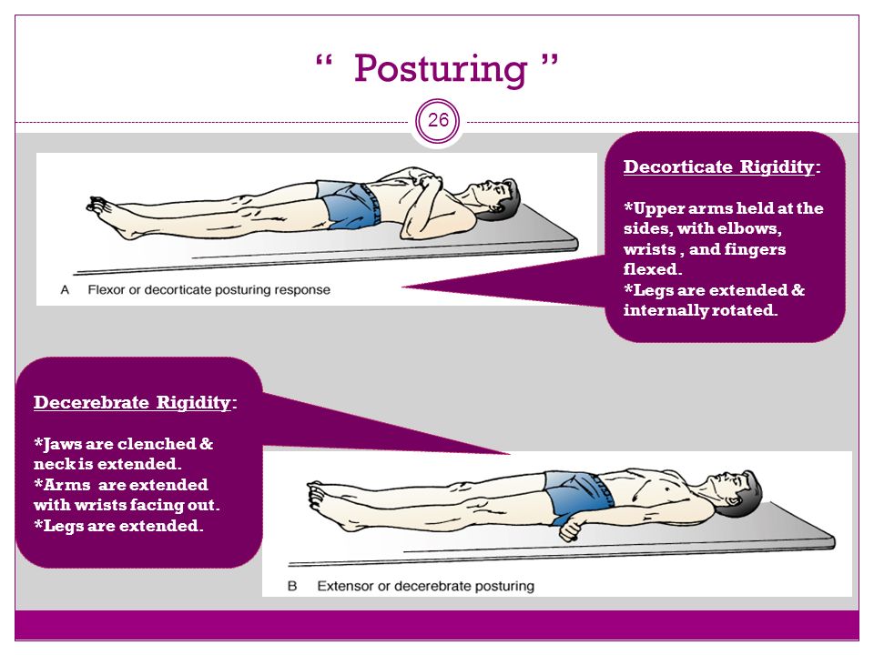 Decerebrate And Decorticate Rigidity Ppt | Bruin Blog