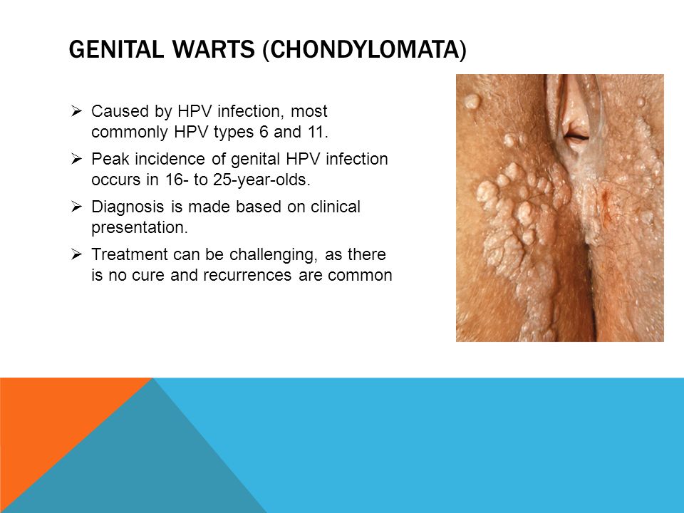genital warts hpv type 6 and 11