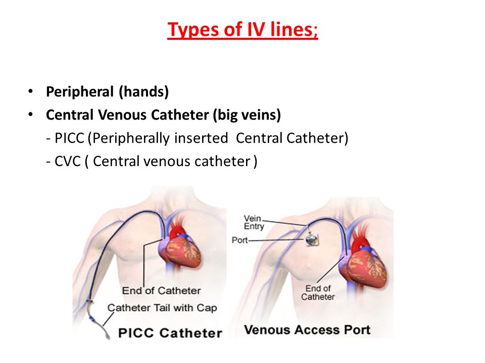 Types Of Cvc Lines