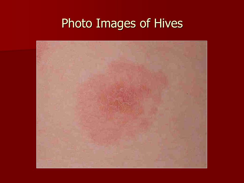 Photo Images of Hives