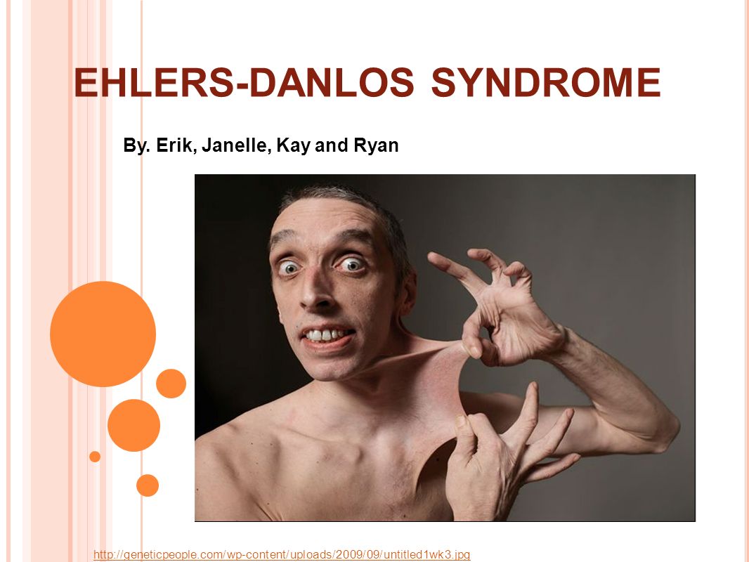 EHLERS-DANLOS SYNDROME.
