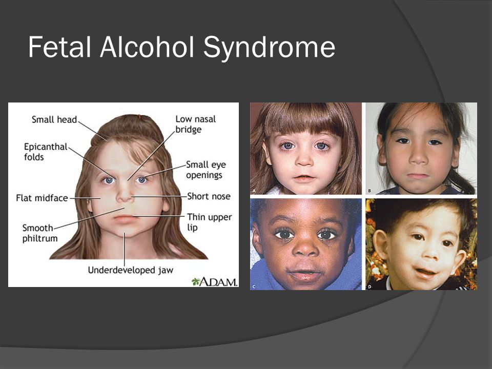 Fetal Alcohol Syndrome.