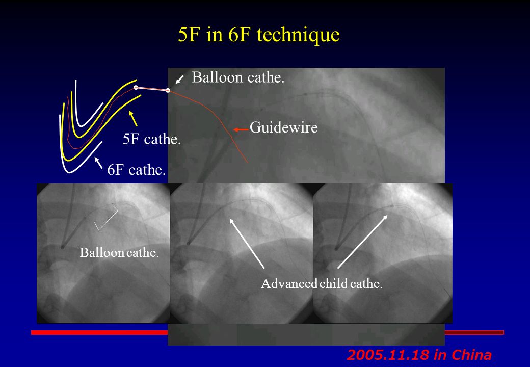 5f In 6f 7f Technique In Des Era Parent Child Catheter