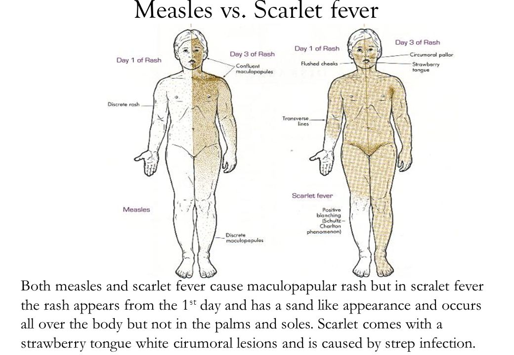 Image result for measles vs scarlet fever"