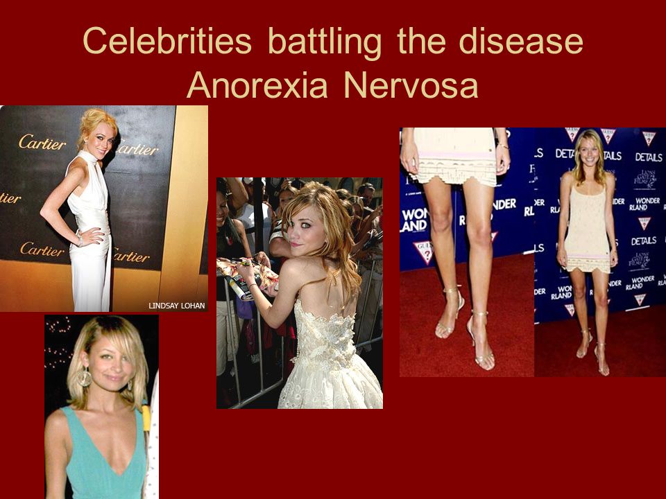 anorexia nervosa celebrities