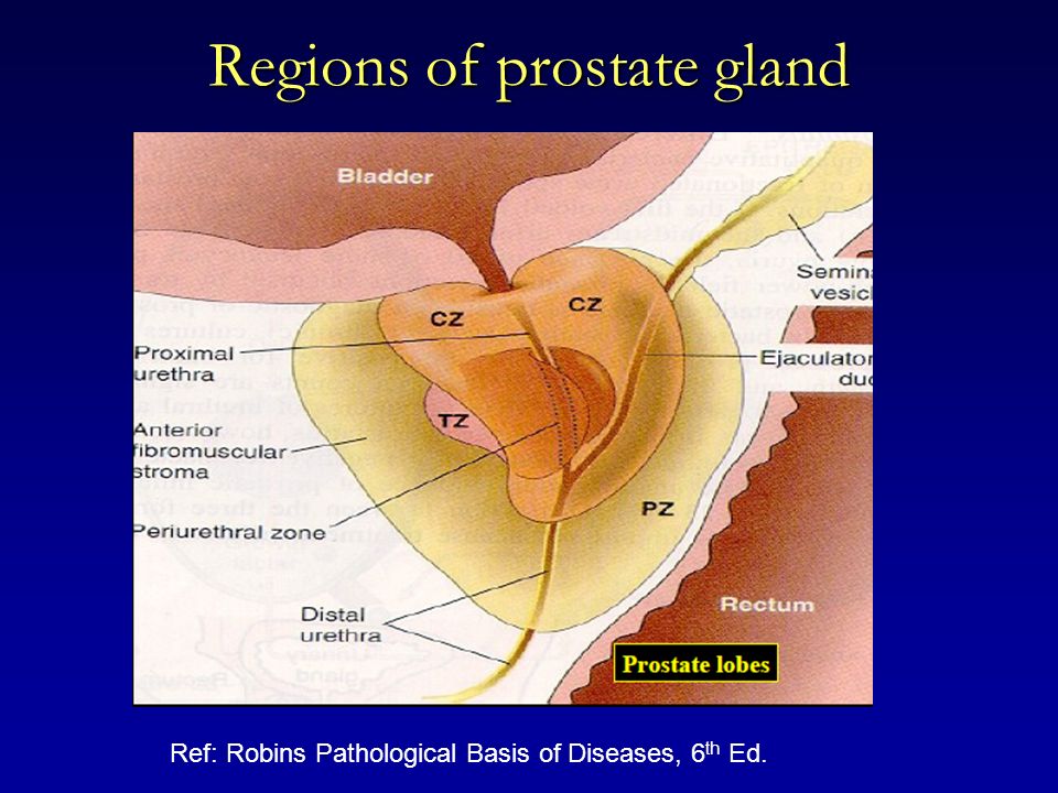 boggy prostate cancer)