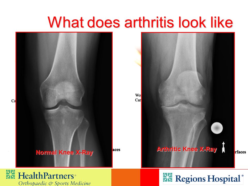 What does arthritis look like